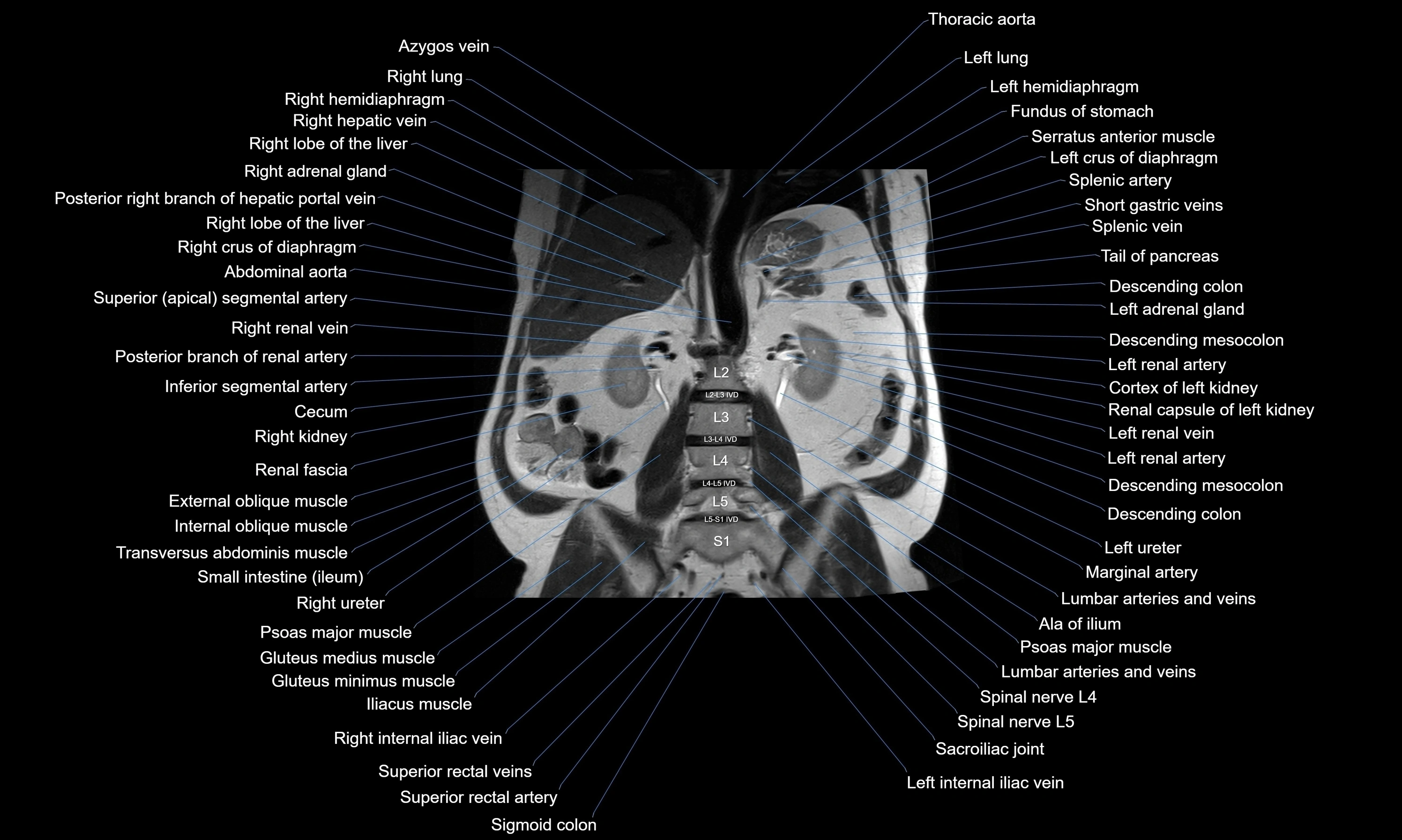 MRI Abdomen axial cross sectional anatomy radiology  image-img-00001-00036.webp